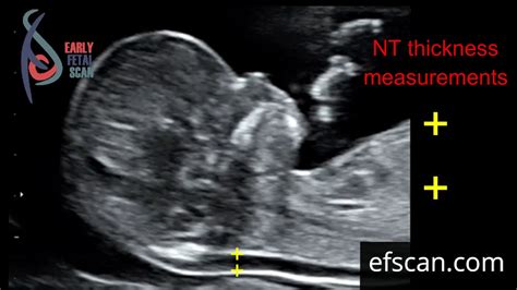 ultrasound fetal nuchal thickness measurement|nuchal translucent fetus.